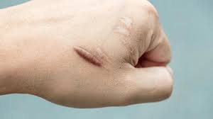 Mengatasi Keloid Secara Alami dengan Perawatan Herbal